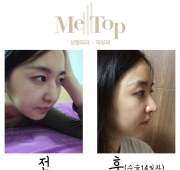 코수술(14일)