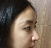 코수술(14일)