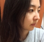 코수술(한달)