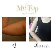 쵸코렛주사 맞…
