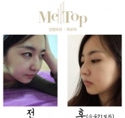코수술(21일)