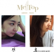 코수술(한달)