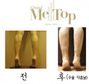 종아리퇴축술 …