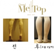 종아리퇴축술 3…