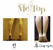 종아리퇴축술 7…